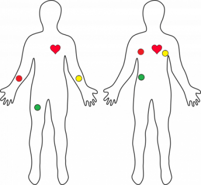 AD8232 placement on Human body